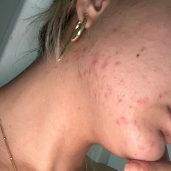 Watsons Çalışan Tavsiyesiyle Aldığım Ürünler Cildimi Mahvetti