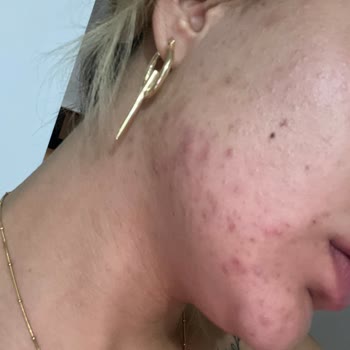 Watsons Çalışan Tavsiyesiyle Aldığım Ürünler Cildimi Mahvetti