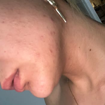 Watsons Çalışan Tavsiyesiyle Aldığım Ürünler Cildimi Mahvetti