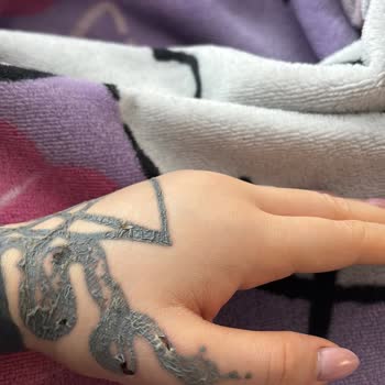 Aydın Üniversitesi Medical Park Dövme Silme İşlemi Sonrası 3. Derece Yanık Mağduriyeti Yaşadık!