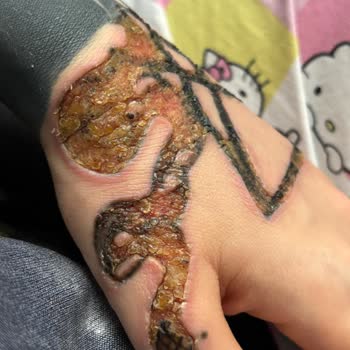 Aydın Üniversitesi Medical Park Dövme Silme İşlemi Sonrası 3. Derece Yanık Mağduriyeti Yaşadık!