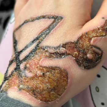 Aydın Üniversitesi Medical Park Dövme Silme İşlemi Sonrası 3. Derece Yanık Mağduriyeti Yaşadık!