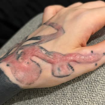 Aydın Üniversitesi Medical Park Dövme Silme İşlemi Sonrası 3. Derece Yanık Mağduriyeti Yaşadık!