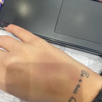 Acil Serviste Yanlış Müdahale Sonrası Morluk Ve Şişlik Endişesi