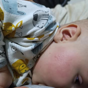 Dalin Bebek Şampuanı Ciltte Kızarıklık Ve Kabarcık Yaptı