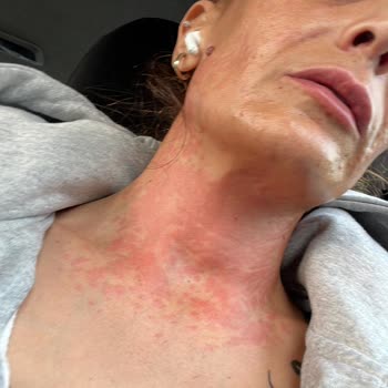 Yüz Maskesi Sonrası Ağır Alerjik Reaksiyon Ve İlgisiz Müşteri Hizmeti Mağduriyeti