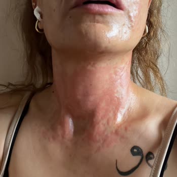 Yüz Maskesi Sonrası Ağır Alerjik Reaksiyon Ve İlgisiz Müşteri Hizmeti Mağduriyeti