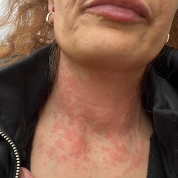 Yüz Maskesi Sonrası Ağır Alerjik Reaksiyon Ve İlgisiz Müşteri Hizmeti Mağduriyeti