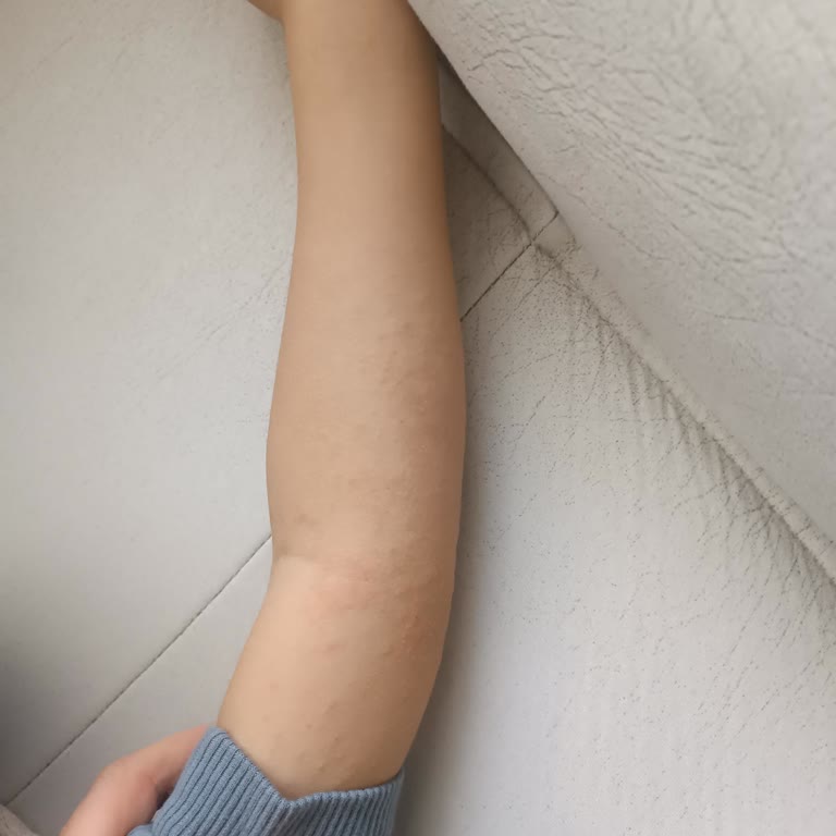 Orzax Ocean D3 Damla Sonrası Çocuğumda Ciddi Cilt Reaksiyonu Ve Egzama Gelişti