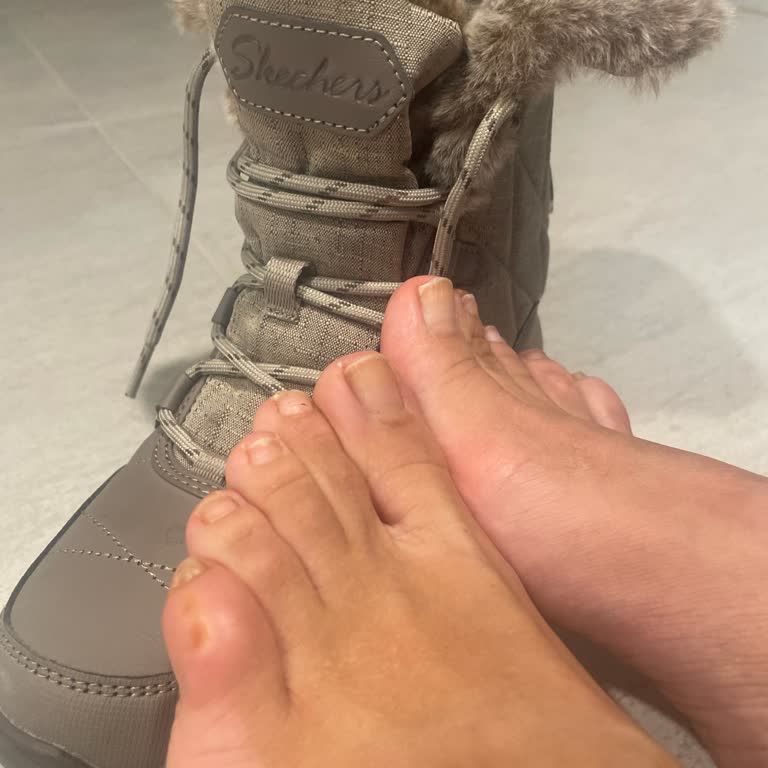 Skechers Botlar İlk Kullanımda Ciddi Rahatsızlık Ve Yara Oluşturdu