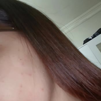 Frudia Yüz Yıkama Köpüğü Sonrası Cildimde Sivilce Problemi Ve Bilgilendirme Eksikliği