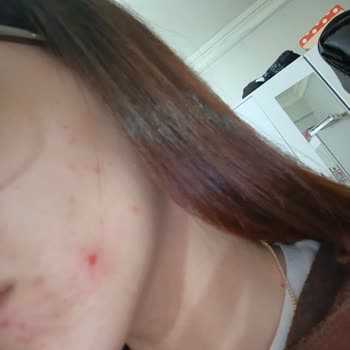 Frudia Yüz Yıkama Köpüğü Sonrası Cildimde Sivilce Problemi Ve Bilgilendirme Eksikliği