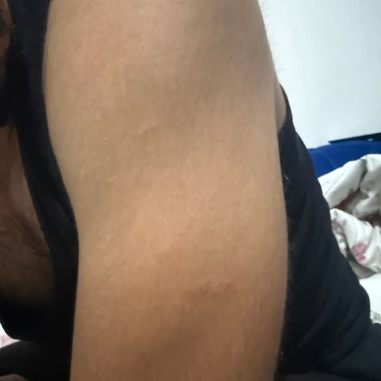 Eski Bir Yara İzi Nedeniyle Mesleki Hayalim Engellendi