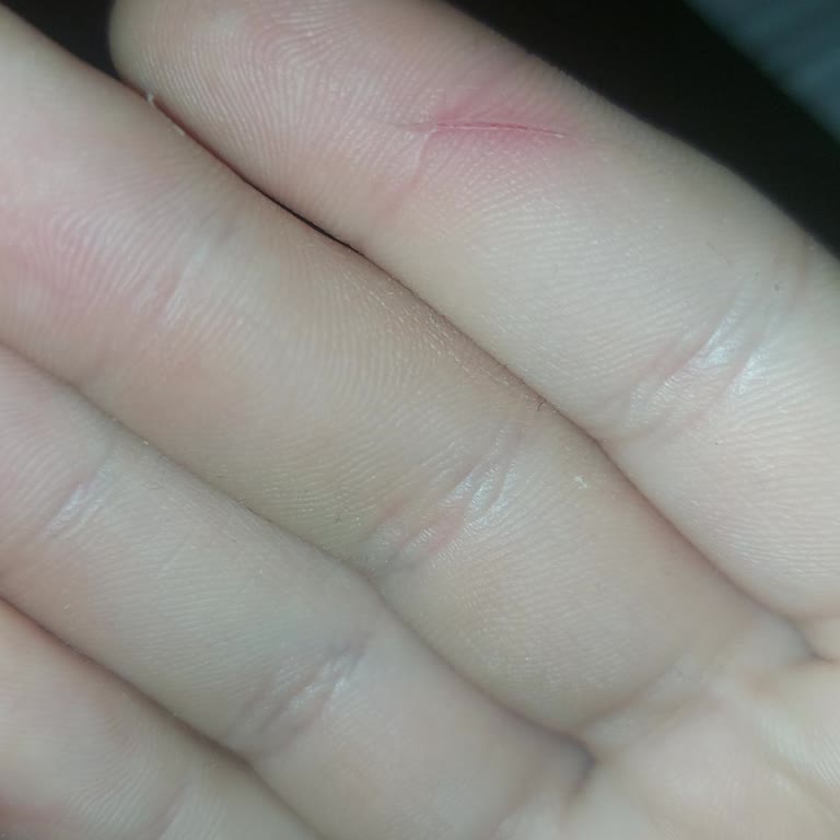 Su Şişesi Kapağının Kesici Yapısı Nedeniyle Yaralanma Ve Güvenlik Endişesi