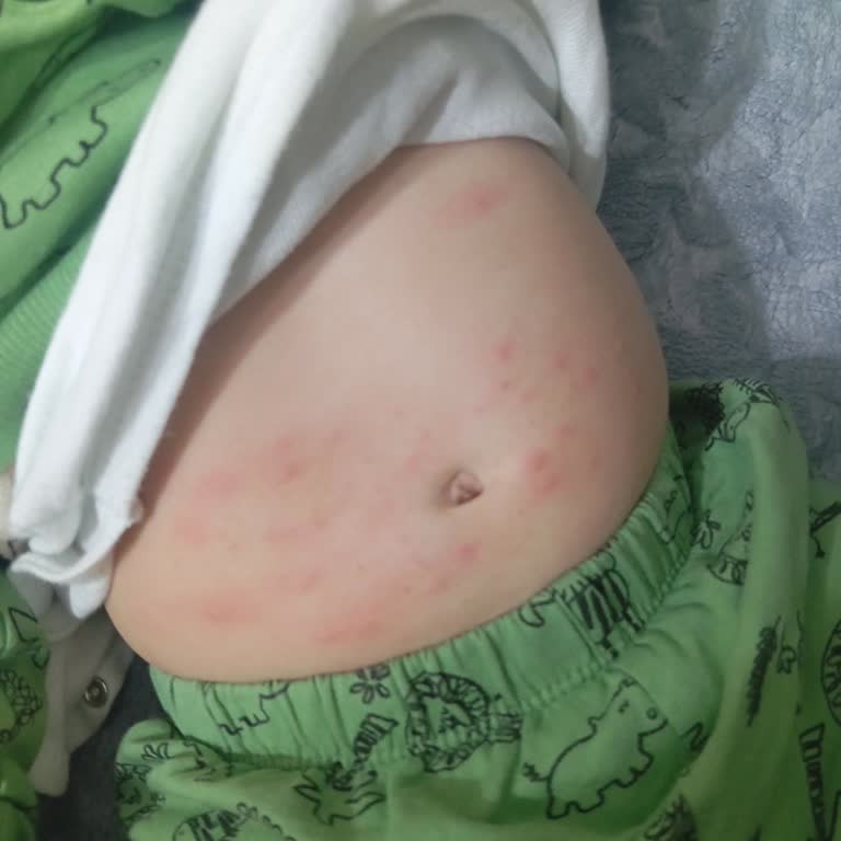 Aptamil 2 Mama Sonrası Bebekte İshal Ve Alerji Yaşadık Benzer Şikayetler Endişelendiriyor