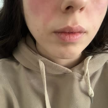 Açık Ve Dökülmüş Gelen Tonik Cildimde Yanma Yaptı, İade Talebim Reddedildi