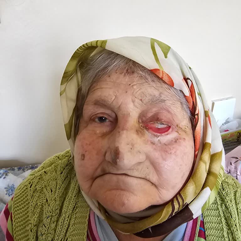 Ameliyat Sonrası Göz Kapağı Sorunu Ve Ek Ücret Talebi Nedeniyle Mağduriyet