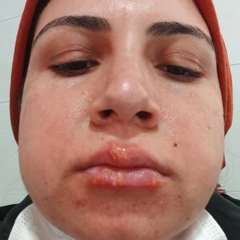 Diş Çekimi Sonrası Yaşadığım Ağrı, İlgisizlik Ve Enfeksiyon Nedeniyle Mağduriyetim