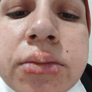 Diş Çekimi Sonrası Yaşadığım Ağrı, İlgisizlik Ve Enfeksiyon Nedeniyle Mağduriyetim