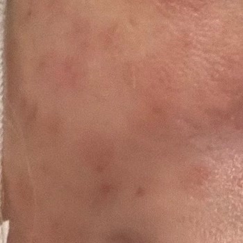 Expigment 4 Krem Kullanımı Sonrası Yüzümde Ciddi Yan Etkiler Ve Kalıcı İz Endişesi