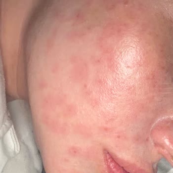 Expigment 4 Krem Kullanımı Sonrası Yüzümde Ciddi Yan Etkiler Ve Kalıcı İz Endişesi