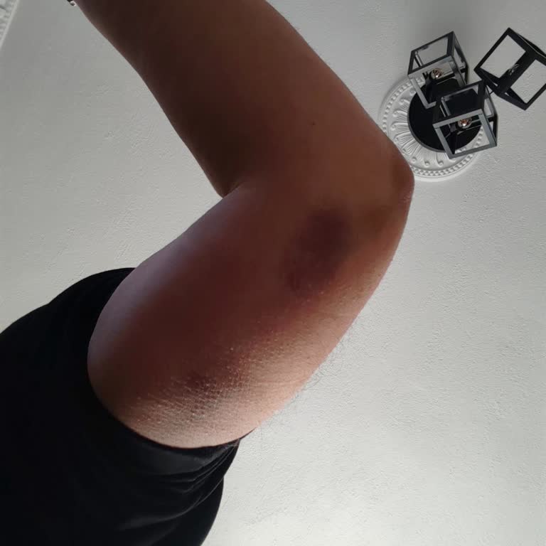 Kaygan Tabanlı Ayakkabı Nedeniyle Yaşanan Güvenlik Sorunu