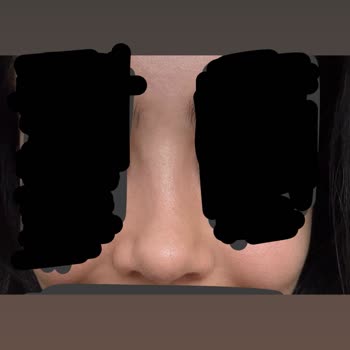 Op. Dr. Atahan Ağrılı Ameliyat Sonrası Nefes Alma Ve Burun Şekli Sorunları Hayat Kalitemi Düşürdü