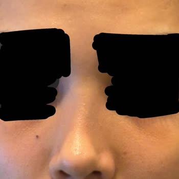 Op. Dr. Atahan Ağrılı Ameliyat Sonrası Nefes Alma Ve Burun Şekli Sorunları Hayat Kalitemi Düşürdü