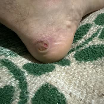 İlk Giyişte Ayağımı Yaralayan Ayakkabı İçin Çözüm Bekliyorum