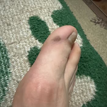 İlk Giyişte Ayağımı Yaralayan Ayakkabı İçin Çözüm Bekliyorum