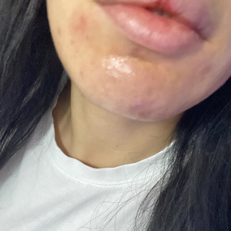 Yanlış Ürün Tavsiyesi Sonucu Yüzümde Ciddi Yanık Ve Kalıcı Hasar Oluştu