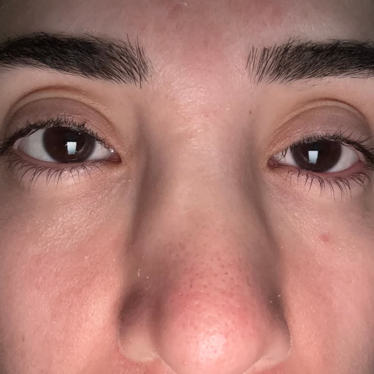 Burun Estetiği Sonrası Hayal Kırıklığı Ve Çözüm Eksikliği