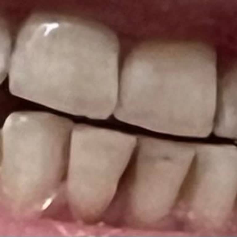 Signal Diş Macunu Dişlerimde Gri Lekeler Oluşturdu, İade Ve Bilgilendirme Talep Ediyorum