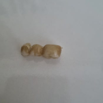 Yeni Yapılan Zirkonyum Kaplama Kısa Sürede Deforme Oldu, Ücret İadesi İstiyorum