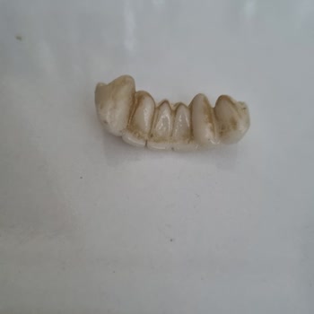 Yeni Yapılan Zirkonyum Kaplama Kısa Sürede Deforme Oldu, Ücret İadesi İstiyorum