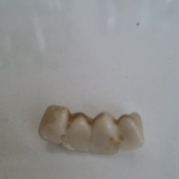 Yeni Yapılan Zirkonyum Kaplama Kısa Sürede Deforme Oldu, Ücret İadesi İstiyorum