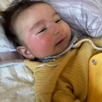 Bebek Havlusu Yüzde Kızarıklık Yaptı, Güvenim Sarsıldı