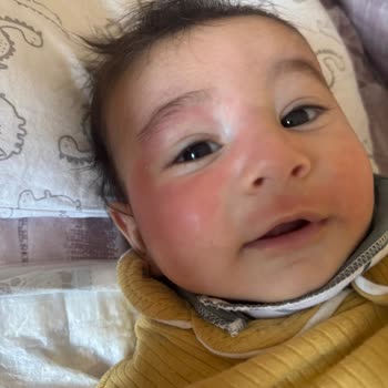 Bebek Havlusu Yüzde Kızarıklık Yaptı, Güvenim Sarsıldı