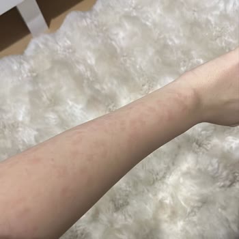 Elif Doğan (Samsun Clinic) Kötü Koşullarda Yapılan İşlem Sonrasında Vücudumda Yanıklar Oluştu