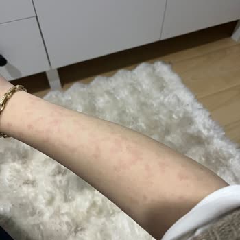 Elif Doğan (Samsun Clinic) Kötü Koşullarda Yapılan İşlem Sonrasında Vücudumda Yanıklar Oluştu