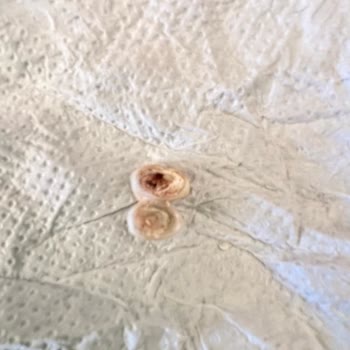 Yanlış Kaplama İşlemiyle Dişim Kırıldı Mağduriyetim Giderilmiyor