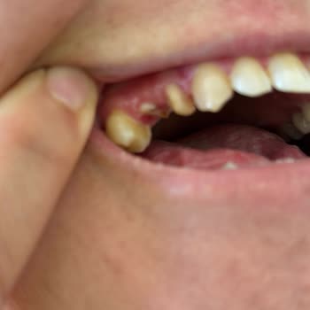 Yanlış Kaplama İşlemiyle Dişim Kırıldı Mağduriyetim Giderilmiyor