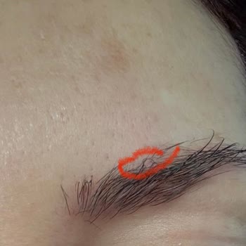 Lazer İşleminde Kaşım Yandı, Doktor İlgisiz Davrandı