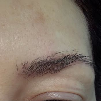 Lazer İşleminde Kaşım Yandı, Doktor İlgisiz Davrandı