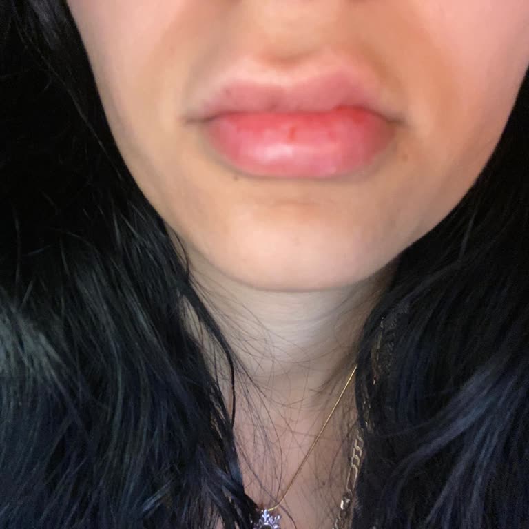 Dudak Dolgusu Sonrası Asimetri Ve İlgisiz Yaklaşım