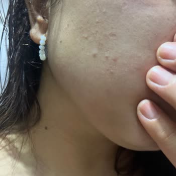 Celenes Ürünleri Kuru Ve Hassas Ciltte Yoğun Sivilce Ve Kızarıklık Yaptı, Çözüm Bekliyorum