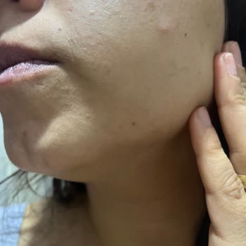 Celenes Ürünleri Kuru Ve Hassas Ciltte Yoğun Sivilce Ve Kızarıklık Yaptı, Çözüm Bekliyorum