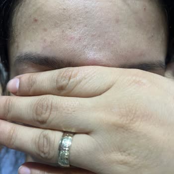 Celenes Ürünleri Kuru Ve Hassas Ciltte Yoğun Sivilce Ve Kızarıklık Yaptı, Çözüm Bekliyorum