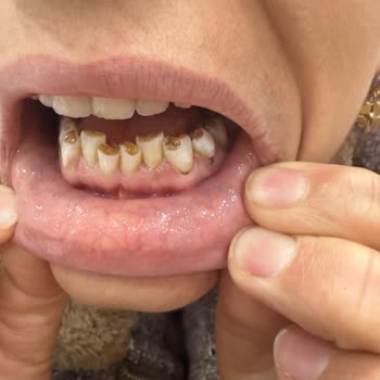 Tedavi Sonrası Dişlerimde Kalıcı Hasar Ve Mağduriyet Yaşıyorum