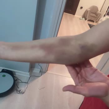 Tedavi Sonrası Dişlerimde Kalıcı Hasar Ve Mağduriyet Yaşıyorum